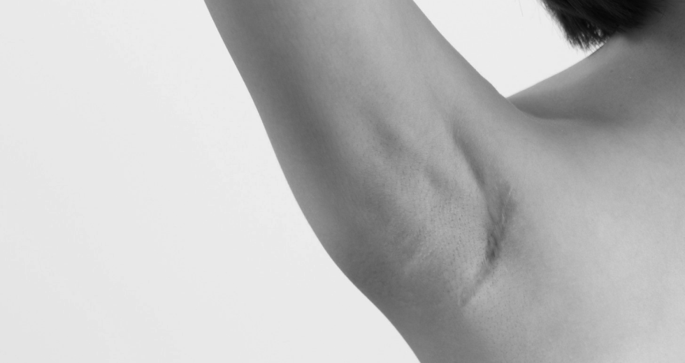 일반적인 흉터위치: 팔꿈치, 겨드랑이 앞, 안쪽