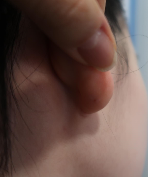 Behind the ear · ear crease