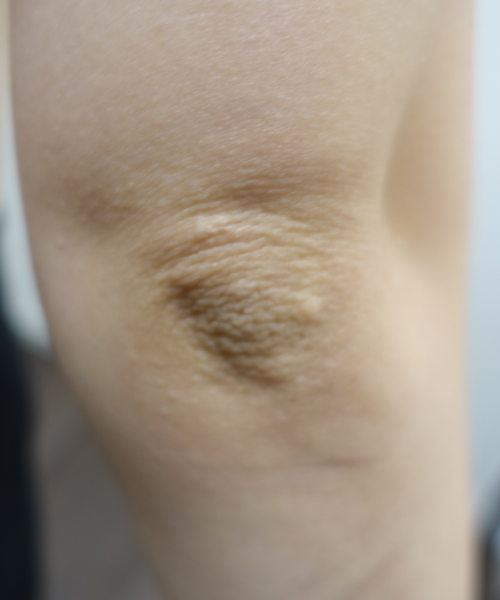 Elbow crease