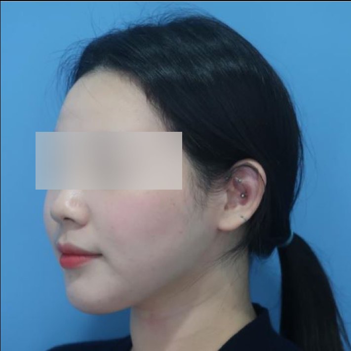 얼굴 지방흡입 수술 후