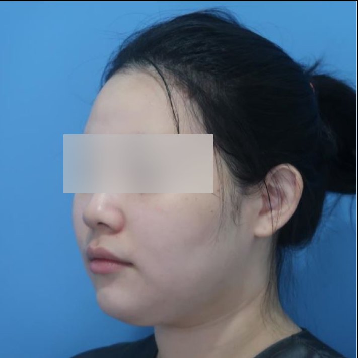 얼굴 지방흡입 수술 전