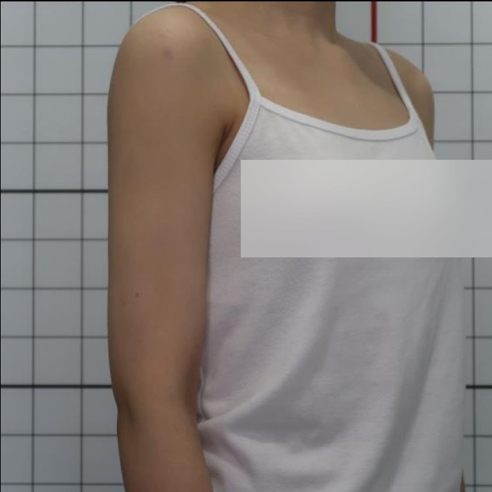 복부 상체 지방흡입 수술 후