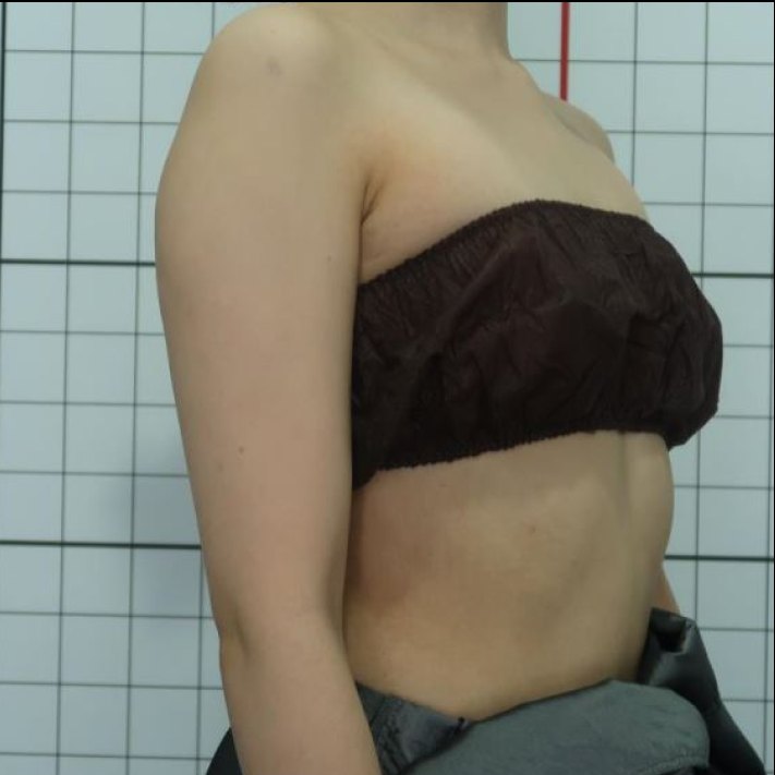 복부 상체 지방흡입 수술 전