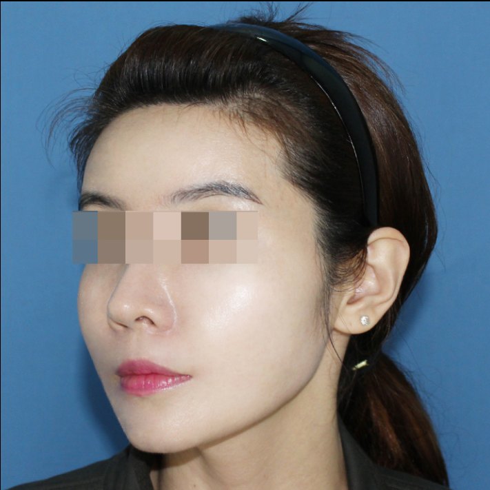 얼굴 지방흡입 수술 후