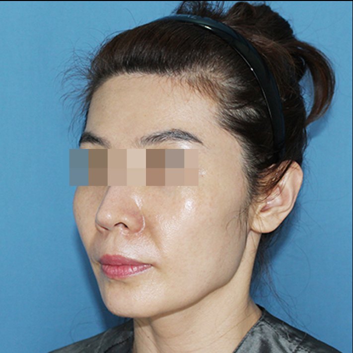 얼굴 지방흡입 수술 전