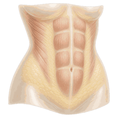 Subcutaneous type — diagram of a thick subcutaneous fat layer over the abdominal muscles